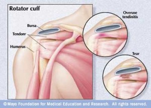 shoulder-tendon